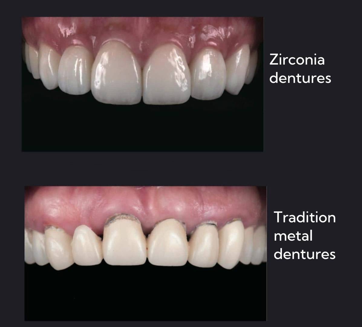 Traditional metal dentures vs zirconia dentures